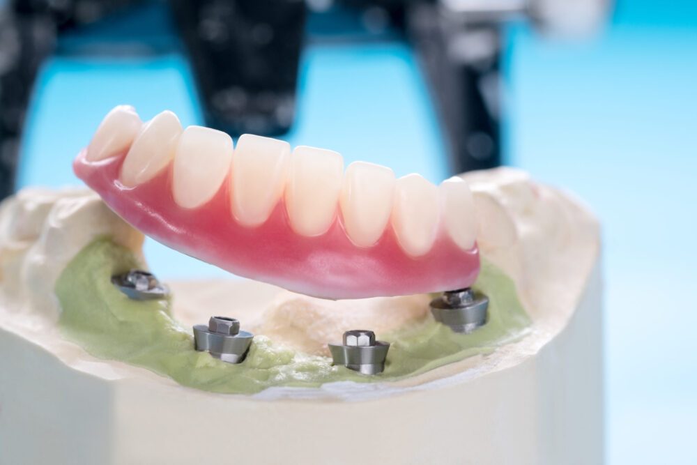 Closeup/,Dental,Implants,Supported,Overdenture,On,Blue,Background/,Screw,Retained/ Closeup/,Dental,Implants,Supported,Overdenture,On,Blue,Background/,Screw,Retained/